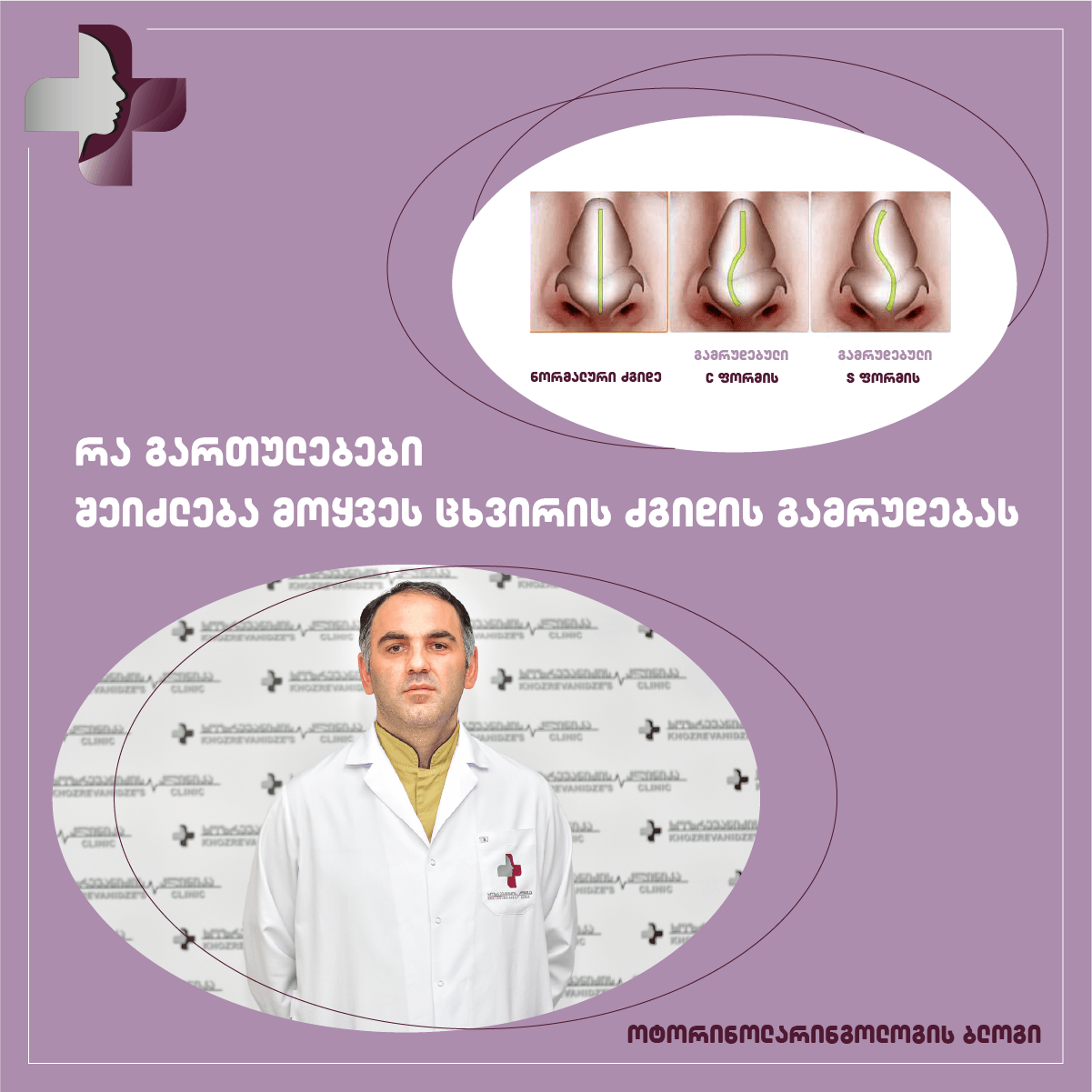 რა გართულებები შეიძლება მოყვეს ცხვირის ძგიდის გამრუდებას