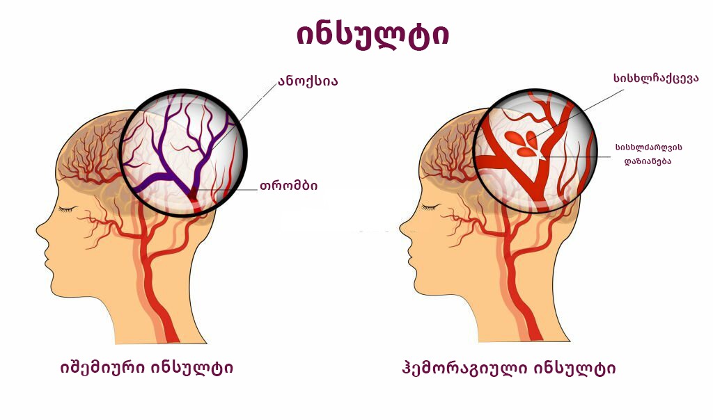 რა არის ინსულტი?
