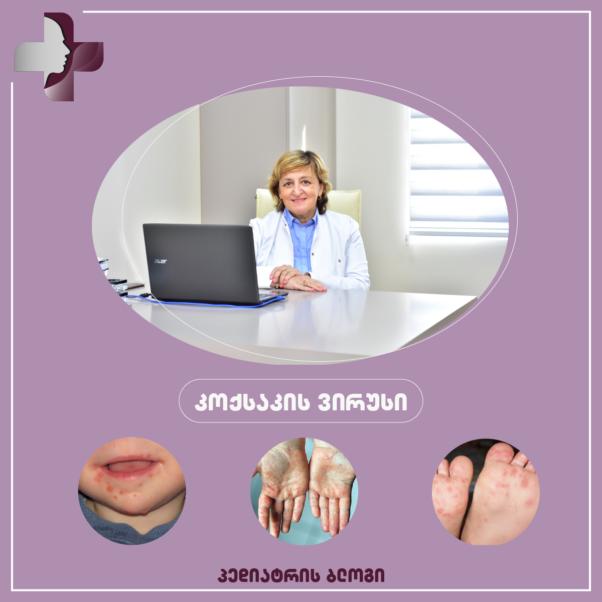 კოქსაკის ვირუსი